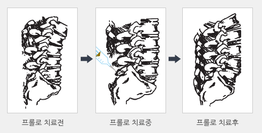 프롤로 치료전 →프롤로 치료중 →프롤로 치료후