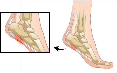 족저근막염 이미지
