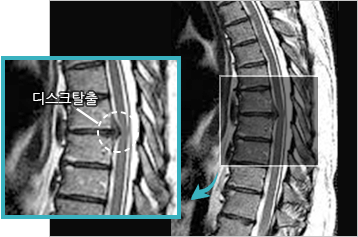 흉추디스크 탈출 이미지