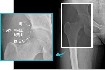 비구 대퇴 충돌 증후군 이미지