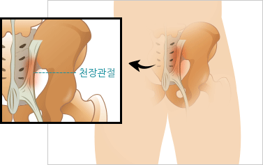 천장관절 증후군 이미지