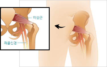 이상근 증후군 이미지