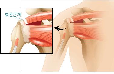 회전근개(Rotator cuff) 이미지