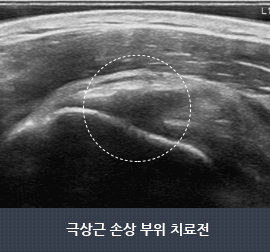 극상근 손상 부위 치료전