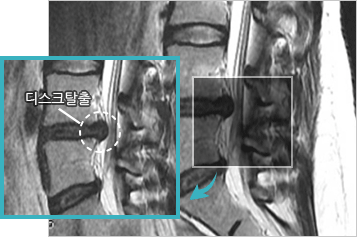 허리디스크 이미지