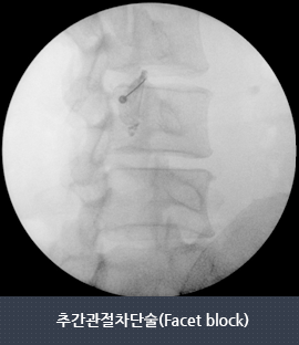 추간관절차단술(Facet block) 이미지