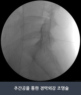 추간공을 통한 경막외강 조영술