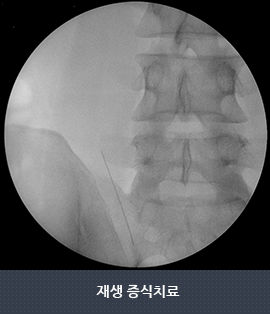 재생 증식치료