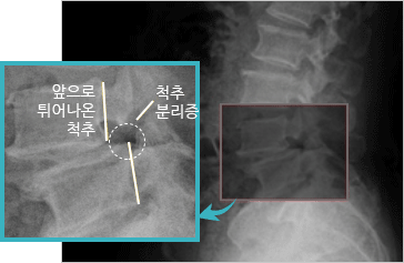 척추 전방위 전위증 이미지