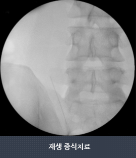 재생 증식치료