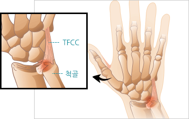 손목 인대 손상(TFCC) 이미지