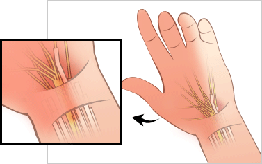 손목터널 이미지