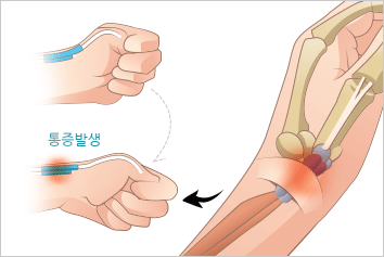 드퀘르벵건초염 이미지